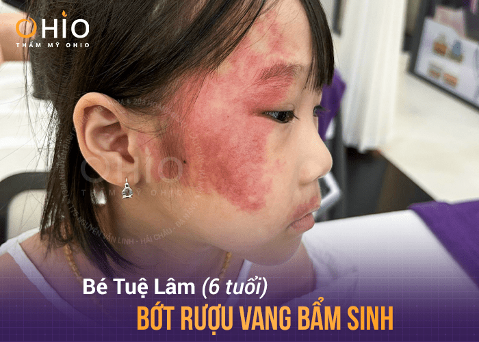 Con gái sạch bớt rượu vang, mẹ “vỡ òa” hạnh phúc - Phòng khám da liễu OHIO xóa chàm bớt rượu vang đỏ bẩm sinh cho con