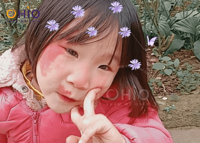 Con gái sạch bớt rượu vang, mẹ “vỡ òa” hạnh phúc - Phòng khám da liễu OHIO Con gái sạch bớt rượu vang, mẹ “vỡ òa” hạnh phúc