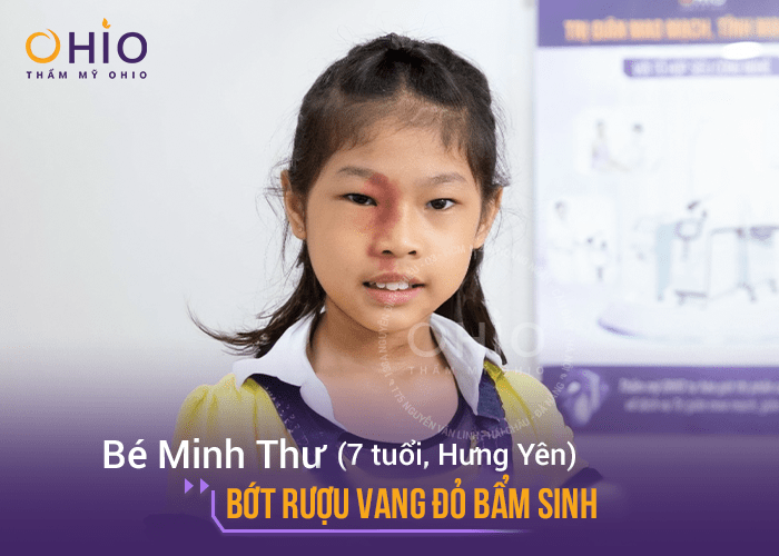 Minh Thư: “Con sạch chàm bớt rồi, đến trường thấy tự tin hơn” - Phòng khám da liễu OHIO bớt rượu vang đỏ bẩm sinh