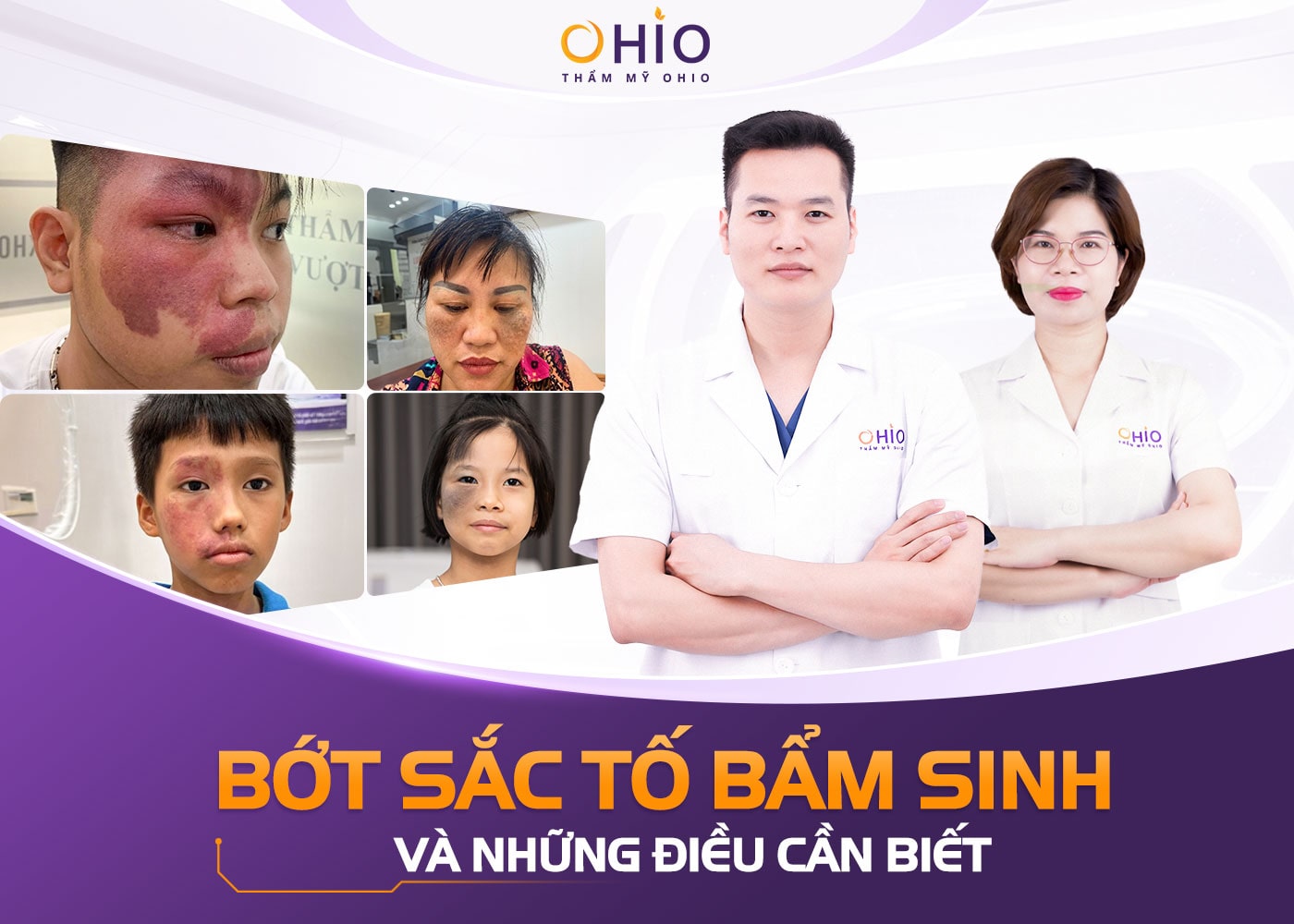 Bớt sắc tố bẩm sinh: Những điều cần biết và cách điều trị an toàn, hiệu quả - Phòng khám da liễu OHIO Chàm bớt sắc tố bẩm sinh