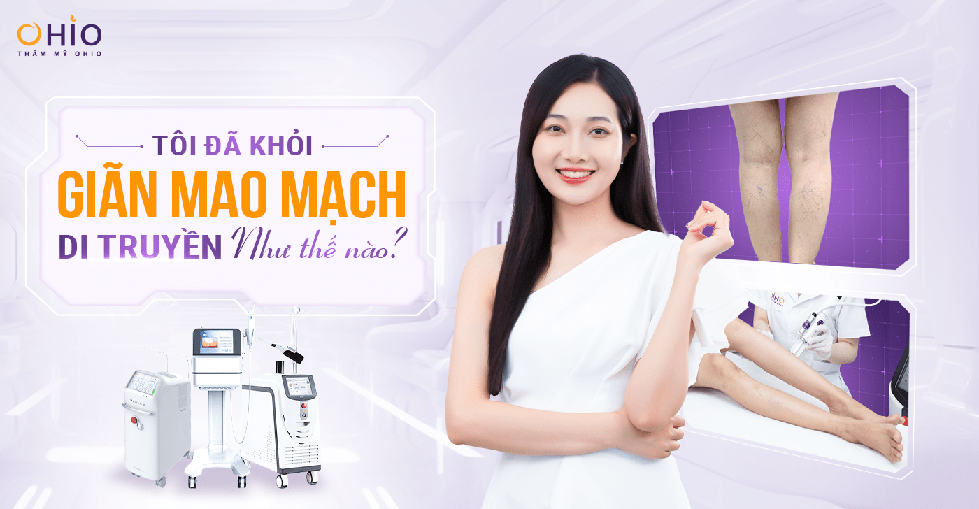Chị Thùy Dương: Tôi đã khỏi Giãn Mao Mạch di truyền như thế nào? - Phòng khám da liễu OHIO Khỏi Giãn Mao Mạch Di Truyền