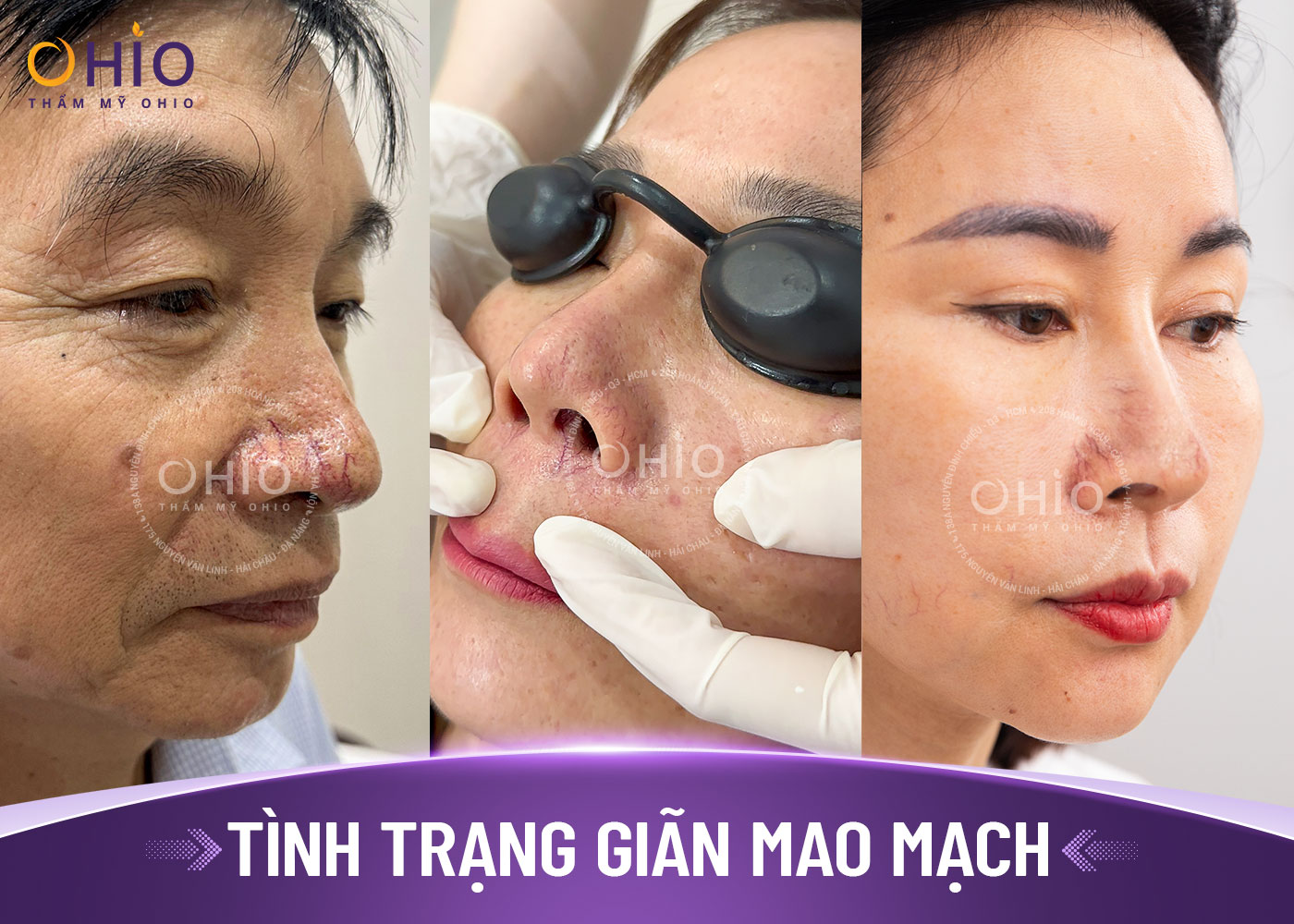 Chi phí điều trị Giãn mao mạch Mũi năm 2025 - Phòng khám da liễu OHIO Chi phí điều trị Giãn mao mạch Mũi