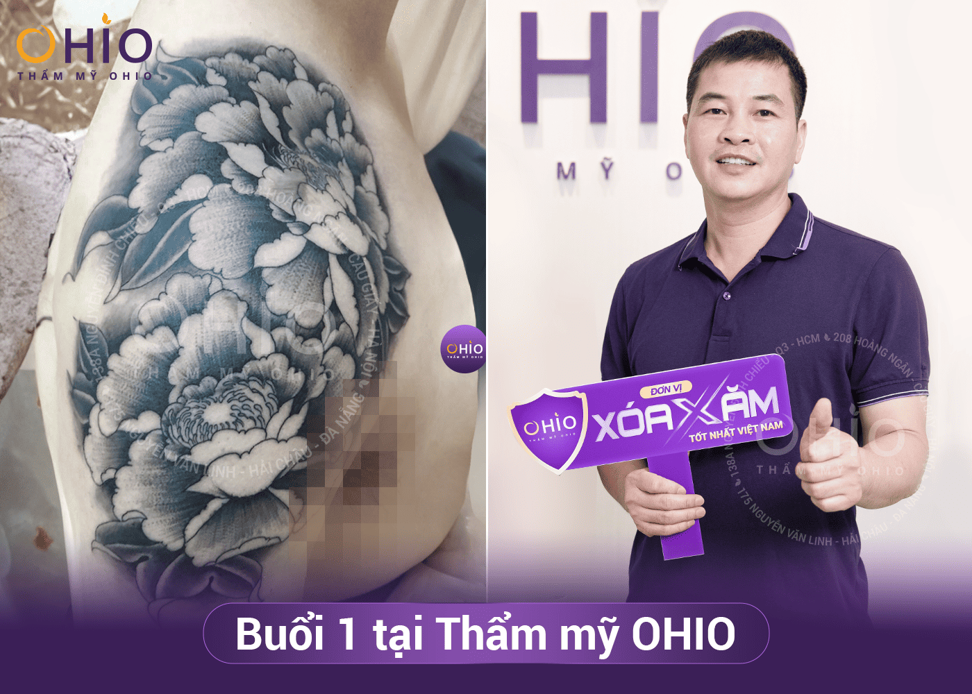 Anh Ngọc Sơn - Thẩm mỹ OHIO đã giúp tôi xóa sạch hình xăm lâu năm! - Phòng khám da liễu OHIO xóa hình xăm lâu năm