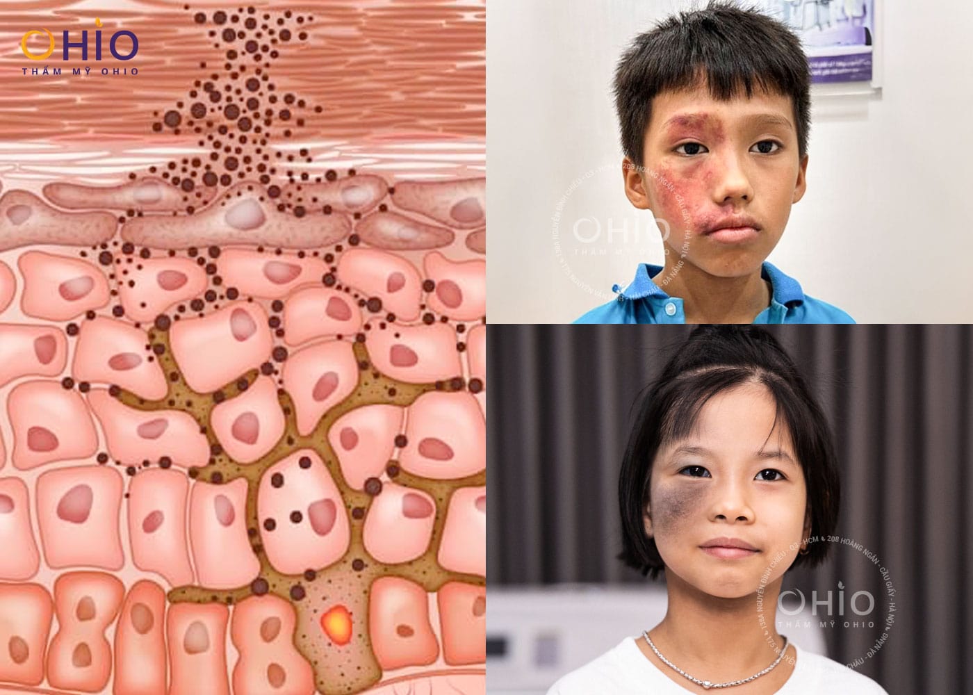 Bớt sắc tố bẩm sinh: Những điều cần biết và cách điều trị an toàn, hiệu quả - Phòng khám da liễu OHIO bớt sắc tố bẩm sinh