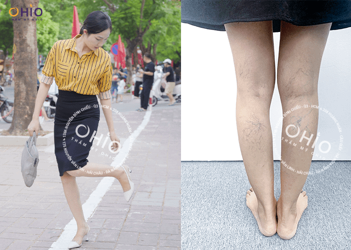 Chị Thùy Dương: Tôi đã khỏi Giãn Mao Mạch di truyền như thế nào? - Phòng khám da liễu OHIO Giãn Mao Mạch Di Truyền