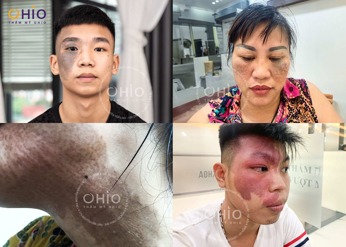 Bớt sắc tố bẩm sinh: Những điều cần biết và cách điều trị an toàn, hiệu quả - Phòng khám da liễu OHIO Bớt sắc tố bẩm sinh: Những điều cần biết và cách điều trị an toàn, hiệu quả