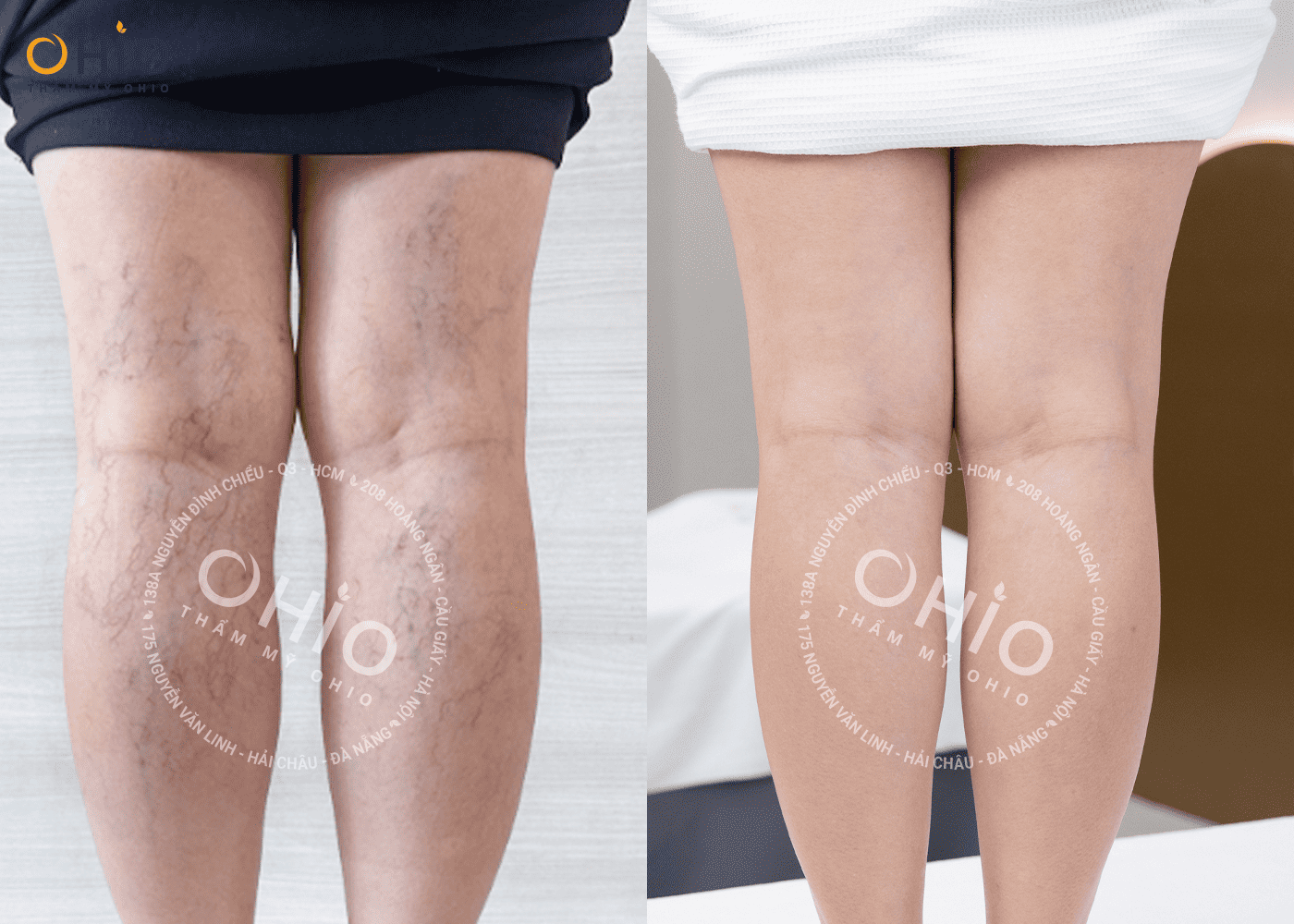 Giải cứu đôi chân giãn mao mạch chằng chịt cho cô giáo Hồng Anh - Phòng khám da liễu OHIO Giải cứu đôi chân giãn mao mạch chằng chịt cho cô giáo Hồng Anh