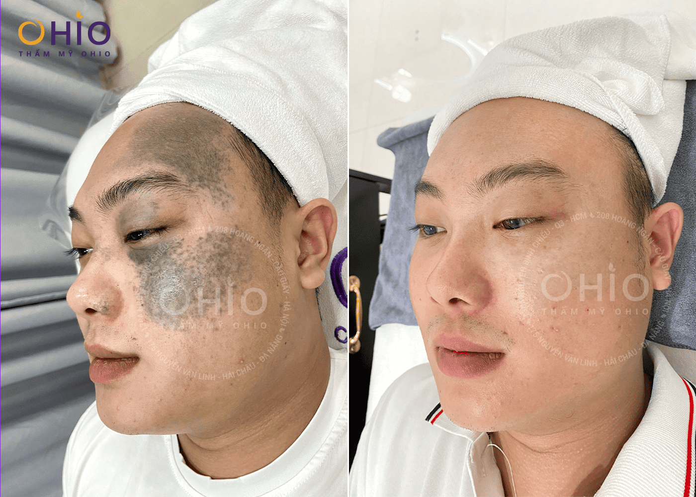 Anh Thế Sơn - Thoát bớt OTA , tự tin làm lại cuộc đời - Phòng khám da liễu OHIO Anh Thế Sơn - Thoát bớt OTA , tự tin làm lại cuộc đời