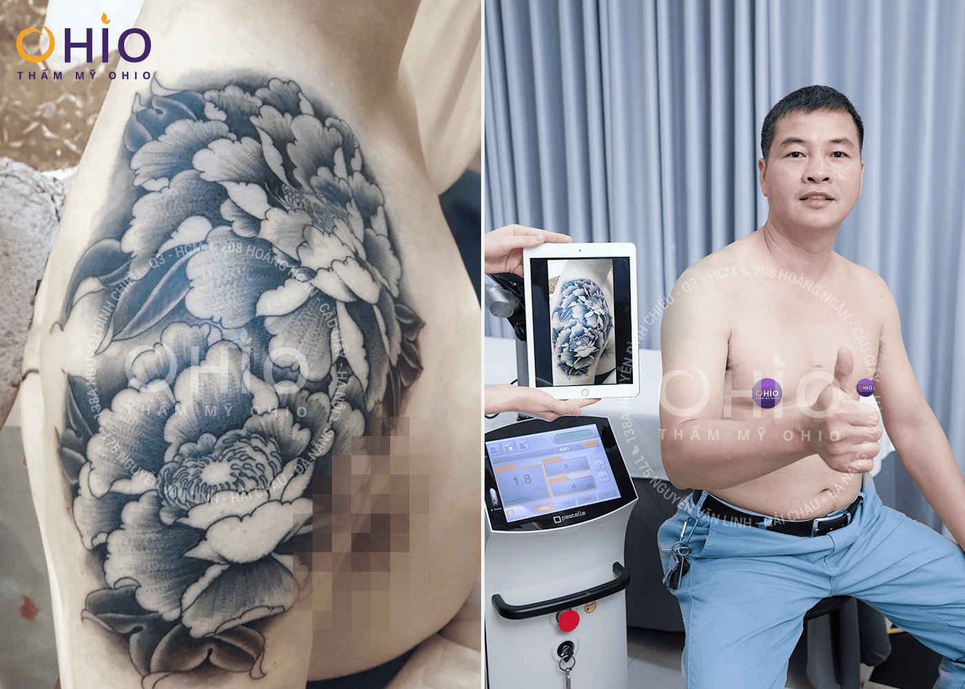 Anh Ngọc Sơn - Thẩm mỹ OHIO đã giúp tôi xóa sạch hình xăm lâu năm! - Phòng khám da liễu OHIO Anh Ngọc Sơn - Thẩm mỹ OHIO đã giúp tôi xóa sạch hình xăm lâu năm!