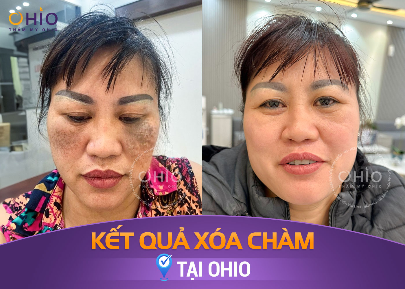 Bớt sắc tố bẩm sinh: Những điều cần biết và cách điều trị an toàn, hiệu quả - Phòng khám da liễu OHIO Bớt sắc tố bẩm sinh: Những điều cần biết và cách điều trị an toàn, hiệu quả