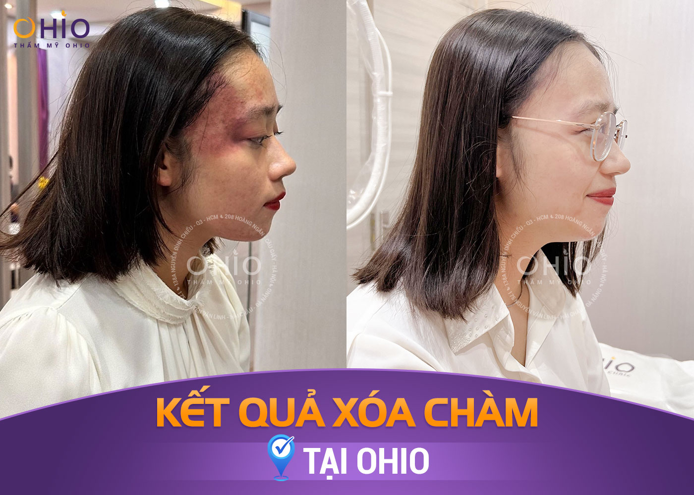Bớt sắc tố bẩm sinh: Những điều cần biết và cách điều trị an toàn, hiệu quả - Phòng khám da liễu OHIO Bớt sắc tố bẩm sinh: Những điều cần biết và cách điều trị an toàn, hiệu quả