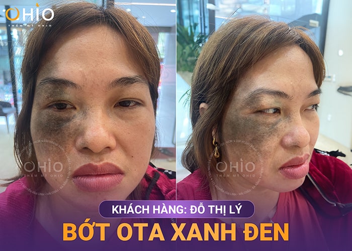Chị Đỗ Lý: Không thể tin có ngày mình được sống với gương mặt sạch chàm - Phòng khám da liễu OHIO chàm OTA xanh đen vùng mặt