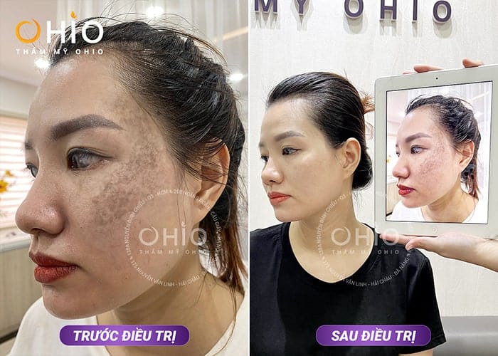 Chị Hạnh vỡ òa hạnh phúc khi xóa sạch chàm bớt trên khuôn mặt - Phòng khám da liễu OHIO Chàm bớt OTA xanh đen