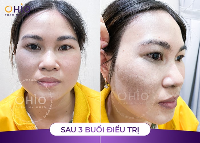 Thoát “ám ảnh” bớt ota xanh đen xấu xí gắn liền suốt 40 năm