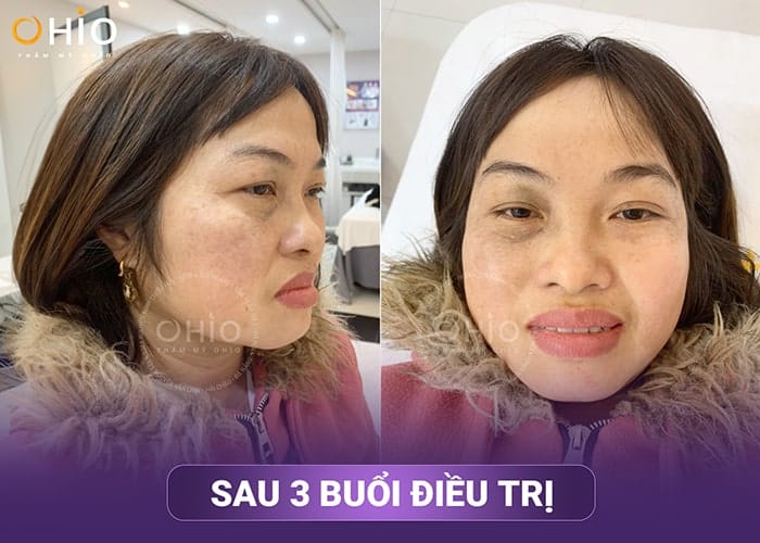 Chị Đỗ Lý: Không thể tin có ngày mình được sống với gương mặt sạch chàm - Phòng khám da liễu OHIO Chị Đỗ Lý: Không thể tin có ngày mình được sống với gương mặt sạch chàm