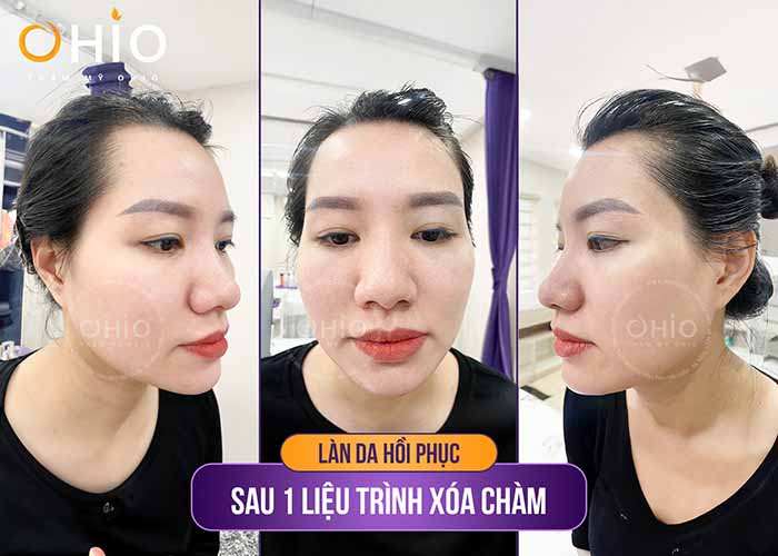 Chị Hạnh vỡ òa hạnh phúc khi xóa sạch chàm bớt trên khuôn mặt - Phòng khám da liễu OHIO Chàm bớt OTA xanh đen