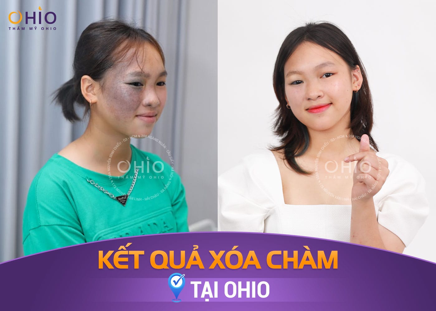 Bớt sắc tố bẩm sinh: Những điều cần biết và cách điều trị an toàn, hiệu quả - Phòng khám da liễu OHIO Bớt sắc tố bẩm sinh: Những điều cần biết và cách điều trị an toàn, hiệu quả