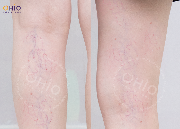 Chị Thanh Tâm: Hết giãn mao mạch chân - tự tin diện váy xinh - Phòng khám da liễu OHIO giãn mao mạch