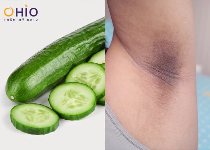 Có cách nào khử thâm toàn thân an toàn, hiệu quả nhanh không?