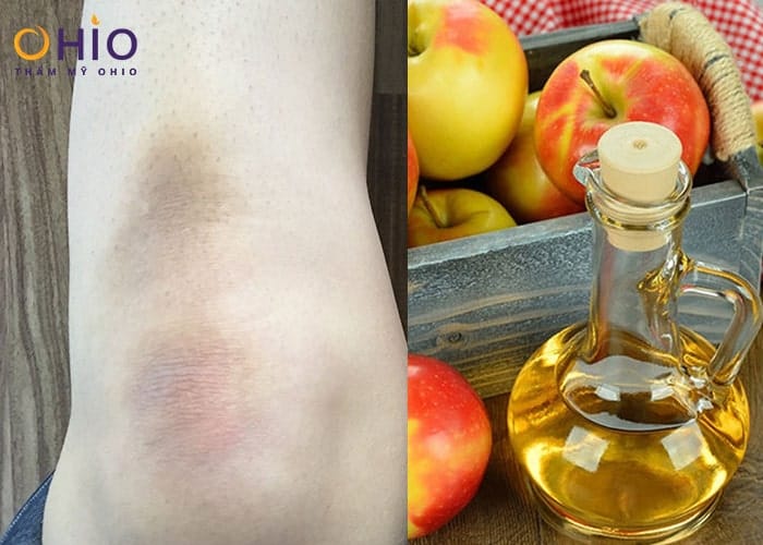 Có cách nào khử thâm toàn thân an toàn, hiệu quả nhanh không?