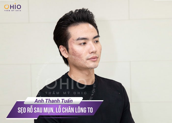 trị sẹo rỗ