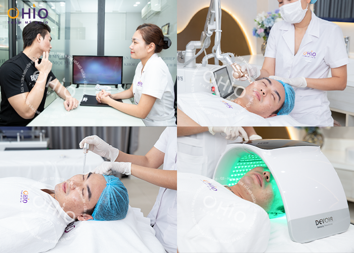 trị sẹo rỗ do mụn