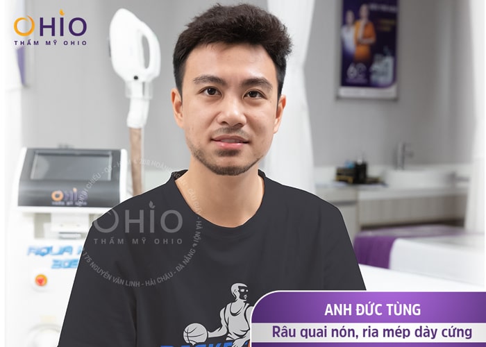 Triệt râu quai nón - bí quyết để luôn bảnh bao của anh Đức Tùng - Phòng khám da liễu OHIO triệt râu vĩnh viễn