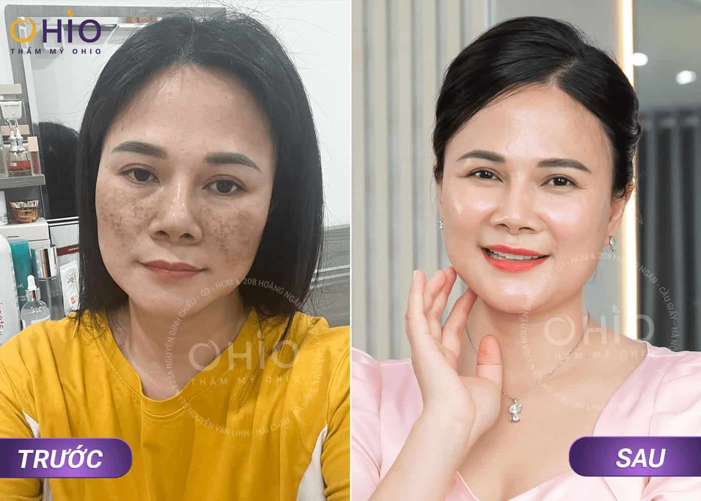 Phương pháp xóa chàm bớt Hori giá bao nhiêu tại Phòng khám OHIO? - Phòng khám da liễu OHIO Phương pháp xóa chàm bớt Hori giá bao nhiêu tại Phòng khám OHIO?