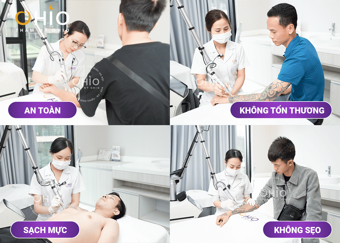 Chi phí xóa xăm tốt 2023 - Chỉ có tại Thẩm mỹ OHIO - Phòng khám da liễu OHIO Chi phí xóa xăm tốt 2023 - Chỉ có tại Thẩm mỹ OHIO