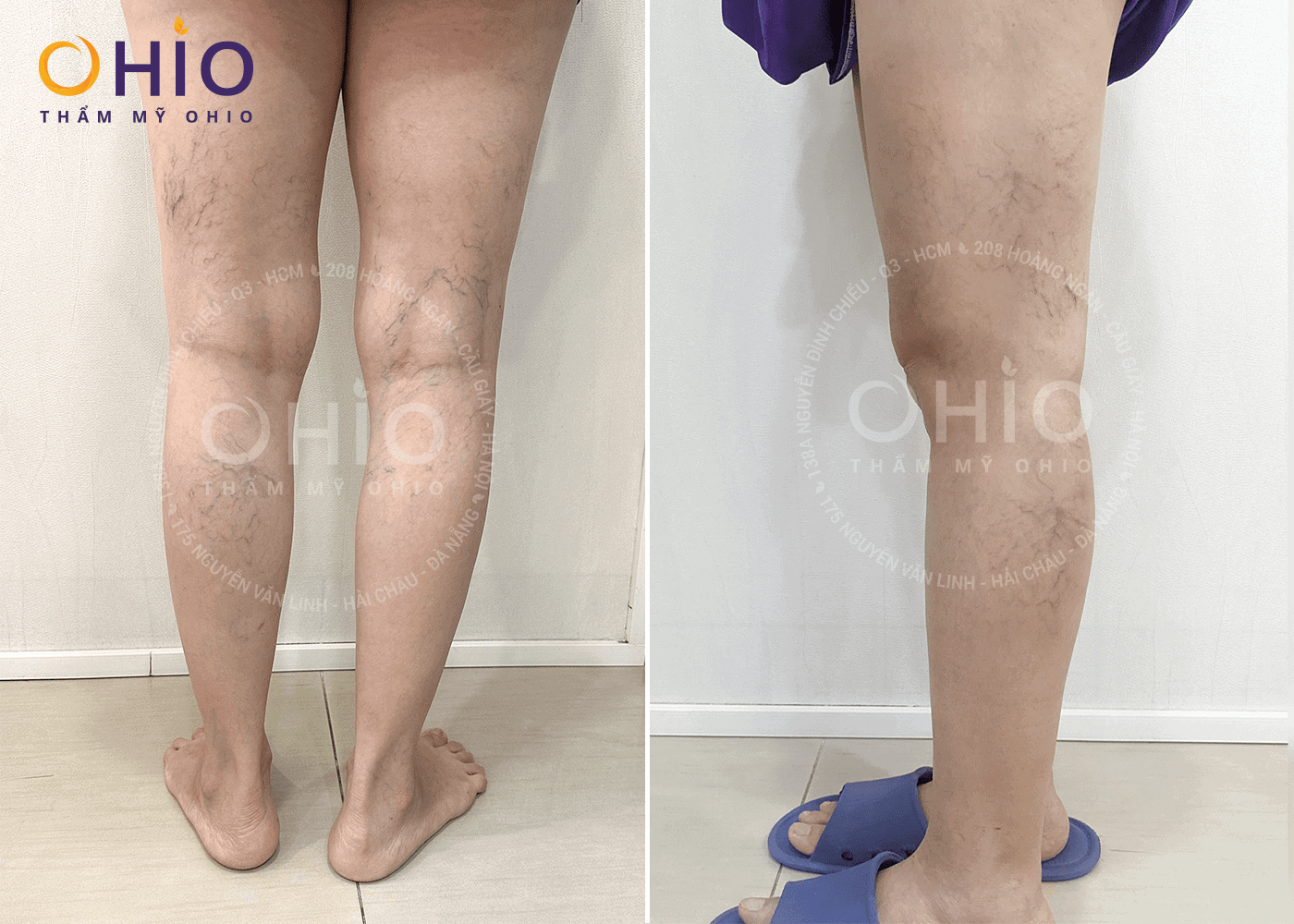 Feedback kết quả trị giãn mao mạch chân của chị Hồng Sen - Phòng khám da liễu OHIO kết quả trị giãn mao mạch chân