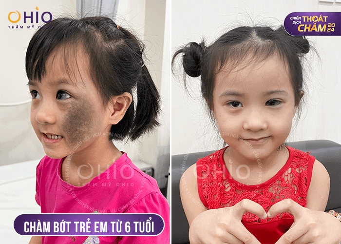 Chiến dịch Thoát chàm 2024 trao cơ hội xóa chàm bớt thay diện mạo đổi cuộc đời cho hàng ngàn khách hàng - Phòng khám da liễu OHIO Chiến dịch Thoát chàm 2024 trao cơ hội xóa chàm bớt thay diện mạo đổi cuộc đời cho hàng ngàn khách hàng