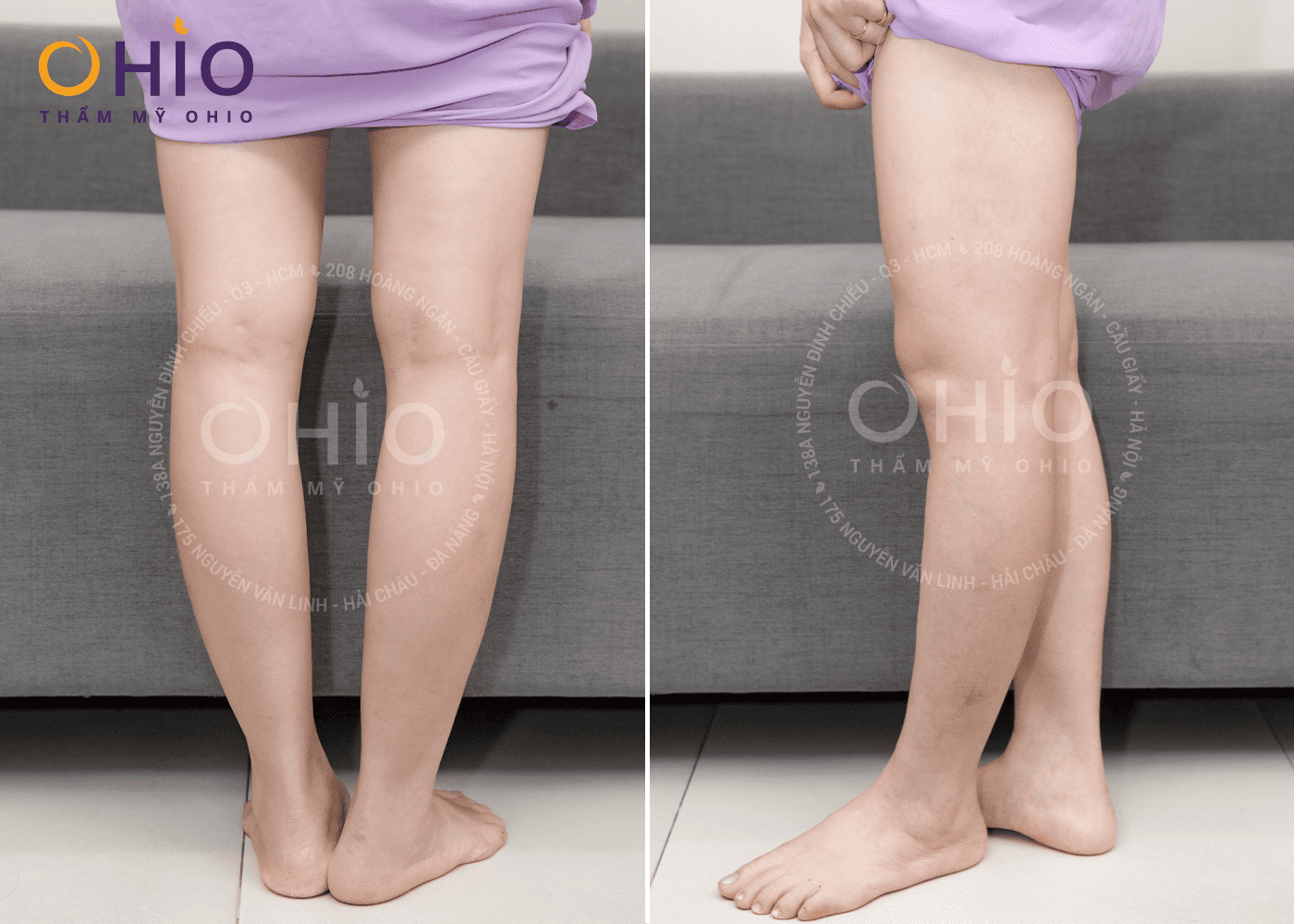 Feedback kết quả trị giãn mao mạch chân của chị Hồng Sen - Phòng khám da liễu OHIO Feedback kết quả trị giãn mao mạch chân của chị Hồng Sen