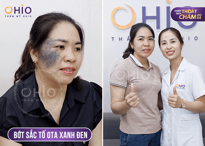 Chiến dịch Thoát chàm 2024 trao cơ hội xóa chàm bớt thay diện mạo đổi cuộc đời cho hàng ngàn khách hàng - Phòng khám da liễu OHIO chiến dịch thoát chàm