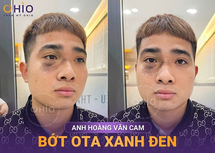 Anh Hoàng Văn Cam: “Sạch chàm giúp tôi có cuộc sống hạnh phúc hơn bên gia đình” - Phòng khám da liễu OHIO Chàm bớt OTA xanh đen