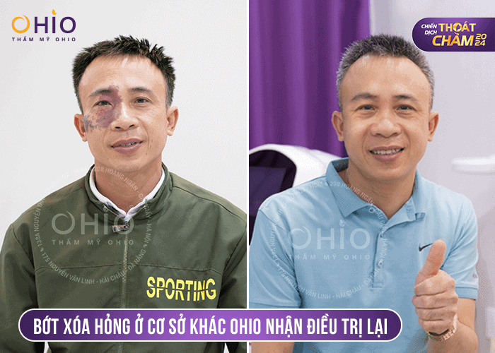 Chiến dịch Thoát Chàm 2024 tài trợ xoá chàm miễn phí 3 tỷ đồng - Phòng khám da liễu OHIO Chiến dịch Thoát Chàm 2024 tài trợ xoá chàm miễn phí 3 tỷ đồng