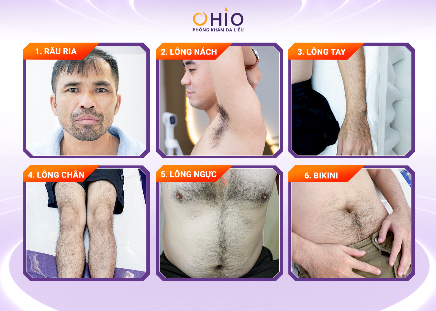 Triệt lông nam toàn thân và những điều cần lưu ý - Phòng khám da liễu OHIO Triệt lông toàn thân