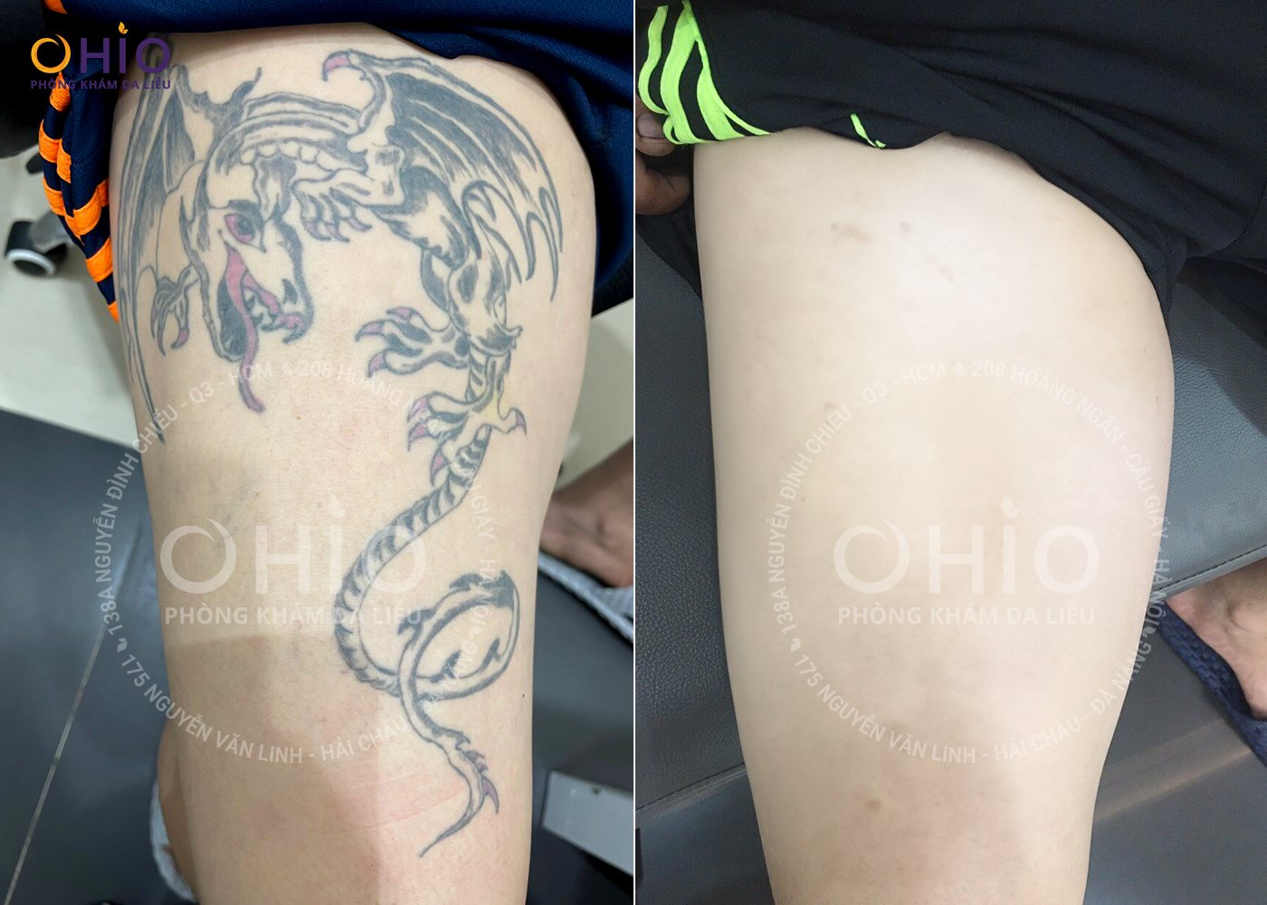 Hình ảnh sau khi xóa xăm bằng Laser tại phòng khám da liễu uy tín - Phòng khám da liễu OHIO xóa xăm
