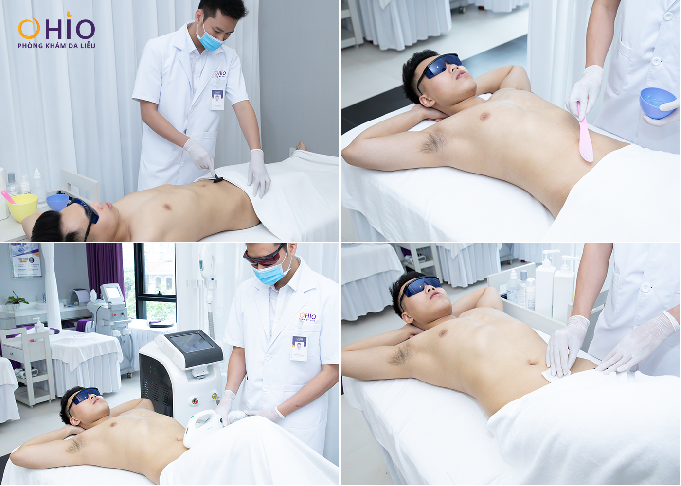 Triệt lông nam toàn thân và những điều cần lưu ý - Phòng khám da liễu OHIO Triệt lông nam toàn thân và những điều cần lưu ý