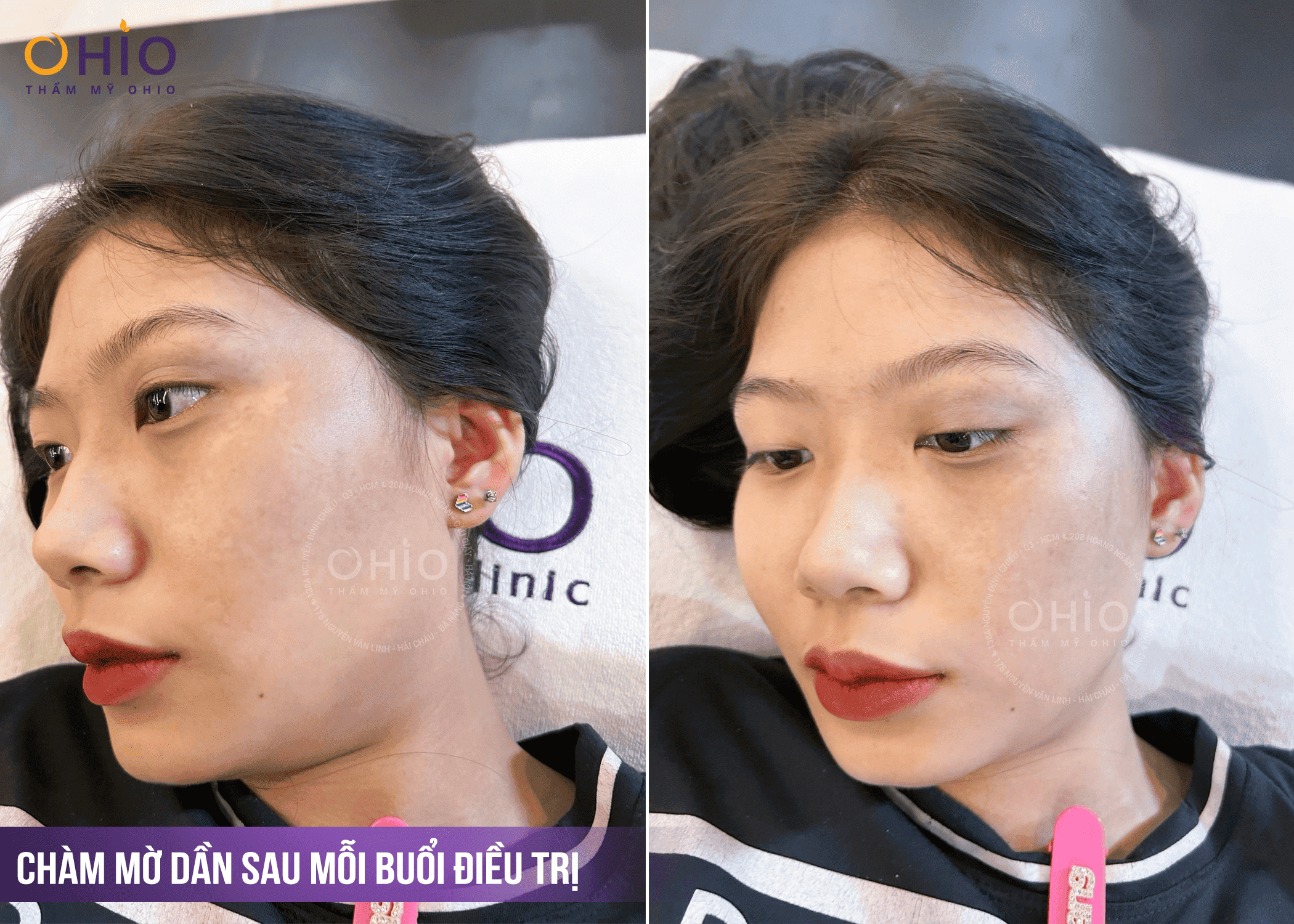 CHÀM BỚT BẨM SINH