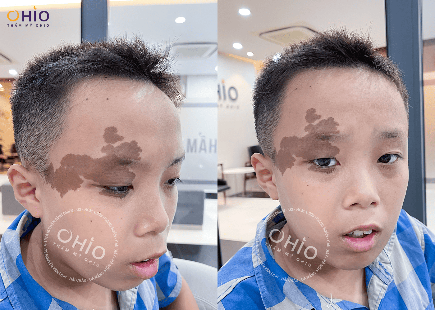 Gia đình Đức Anh: Lựa chọn xóa chàm cho con tại OHIO là sáng suốt! - Phòng khám da liễu OHIO chàm nâu bẩm sinh