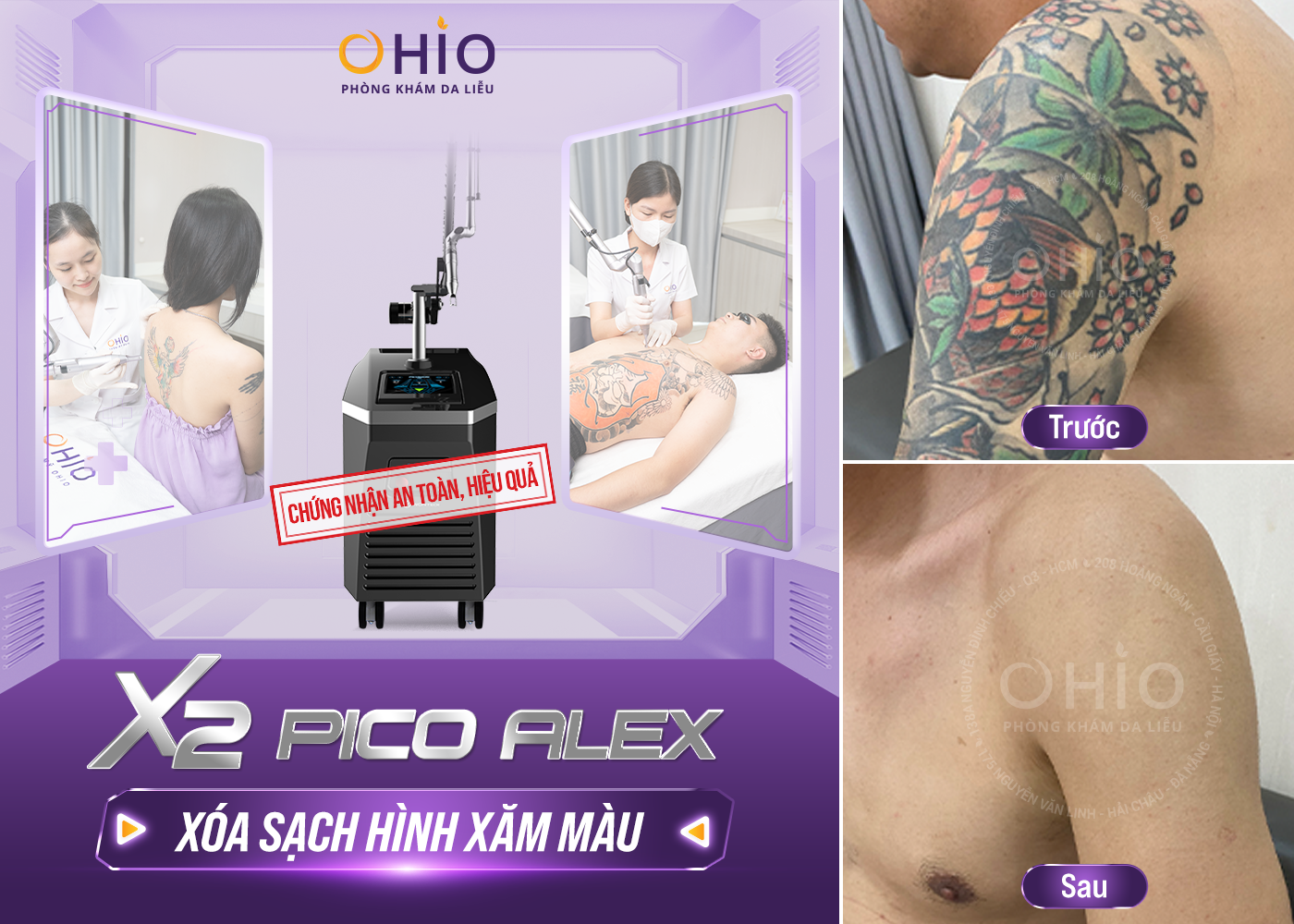 Pico 3X phác đồ Xóa xăm toàn diện đạt chuẩn FDA Hoa Kỳ - Phòng khám da liễu OHIO Pico 3X phác đồ Xóa xăm toàn diện đạt chuẩn FDA Hoa Kỳ