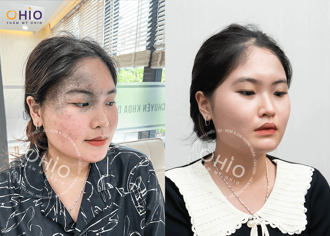 Quỳnh Mai : Xóa sạch chàm bớt tự tin theo đuổi ước mơ - Phòng khám da liễu OHIO điều trị sạch chàm bớt OTA