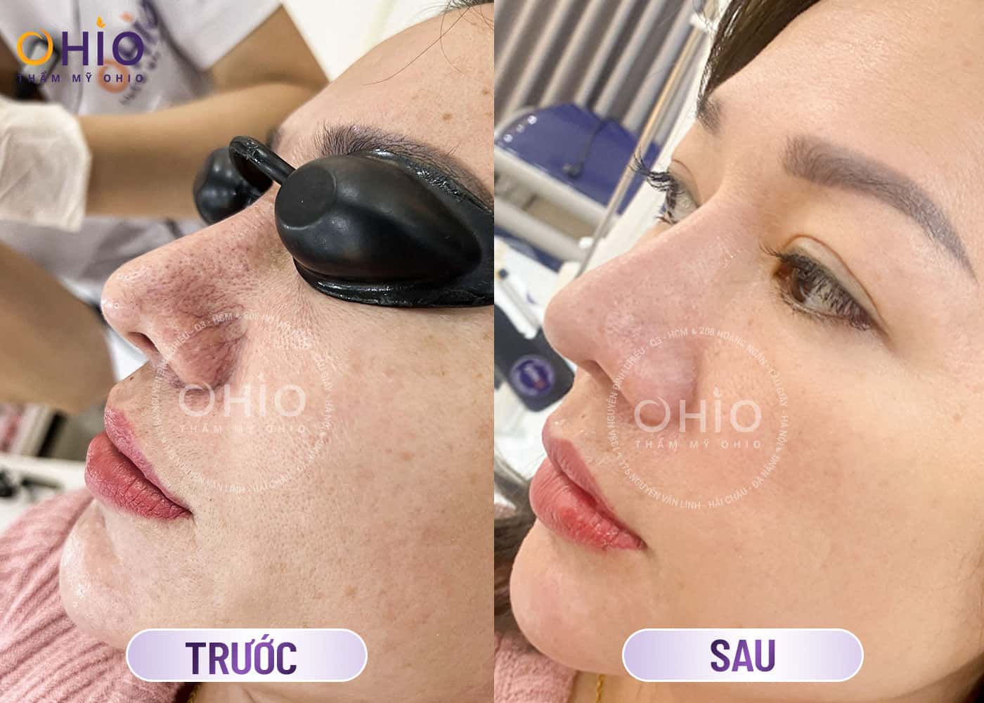Phương pháp điều trị Giãn mao mạch Mũi tốt 2025 - Phòng khám da liễu OHIO Phương pháp điều trị Giãn mao mạch Mũi tốt 2025