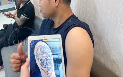 Địa chỉ xóa xăm uy tín tại Sài Gòn