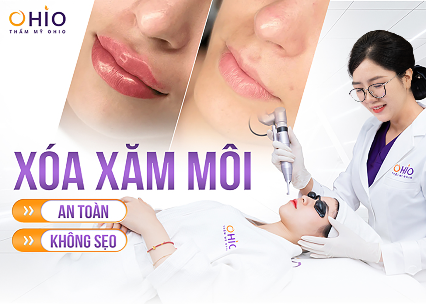 Xóa xăm môi hiệu quả - tối ưu thời gian
