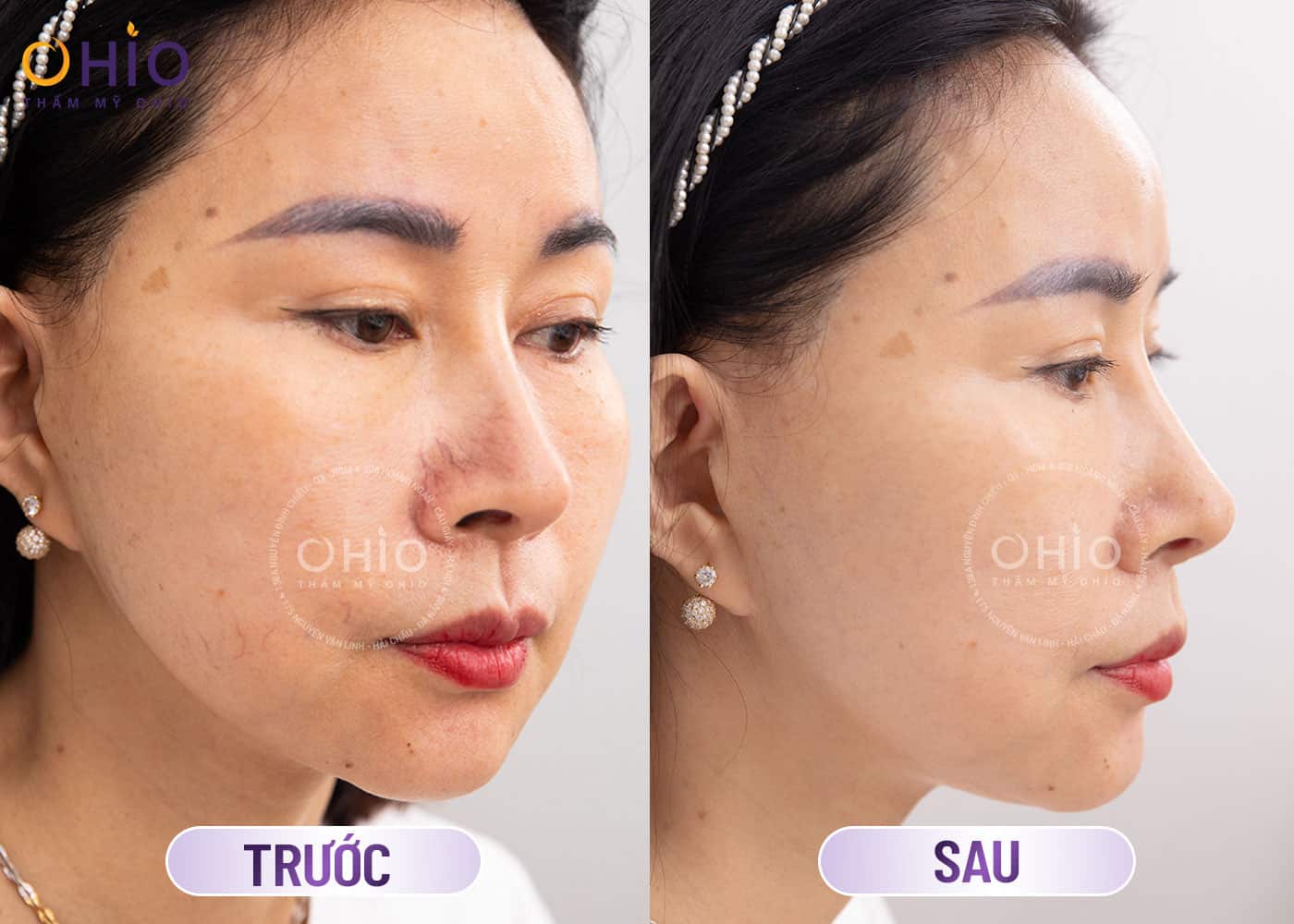 Phương pháp điều trị Giãn mao mạch Mũi tốt 2025 - Phòng khám da liễu OHIO Phương pháp điều trị Giãn mao mạch Mũi tốt 2025
