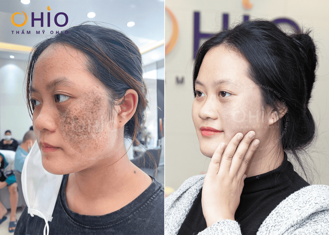 Thùy Dung: Xóa sạch chàm bớt, tương lai rộng mở - Phòng khám da liễu OHIO Thùy Dung: Xóa sạch chàm bớt, tương lai rộng mở