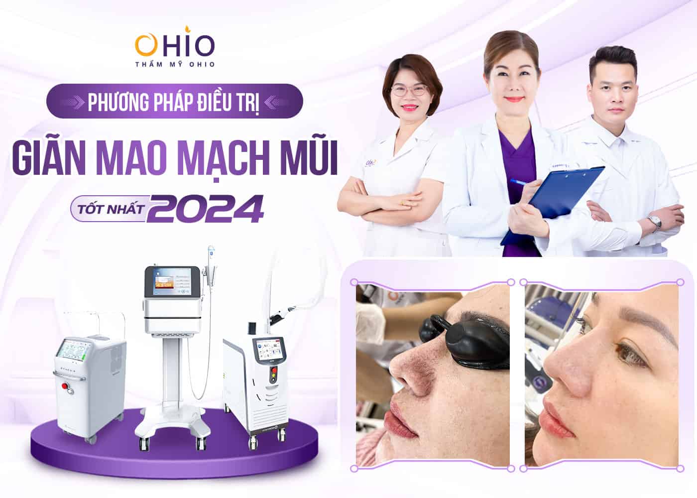 Phương pháp điều trị Giãn mao mạch Mũi tốt 2025 - Phòng khám da liễu OHIO Phương pháp điều trị Giãn mao mạch Mũi tốt 2025