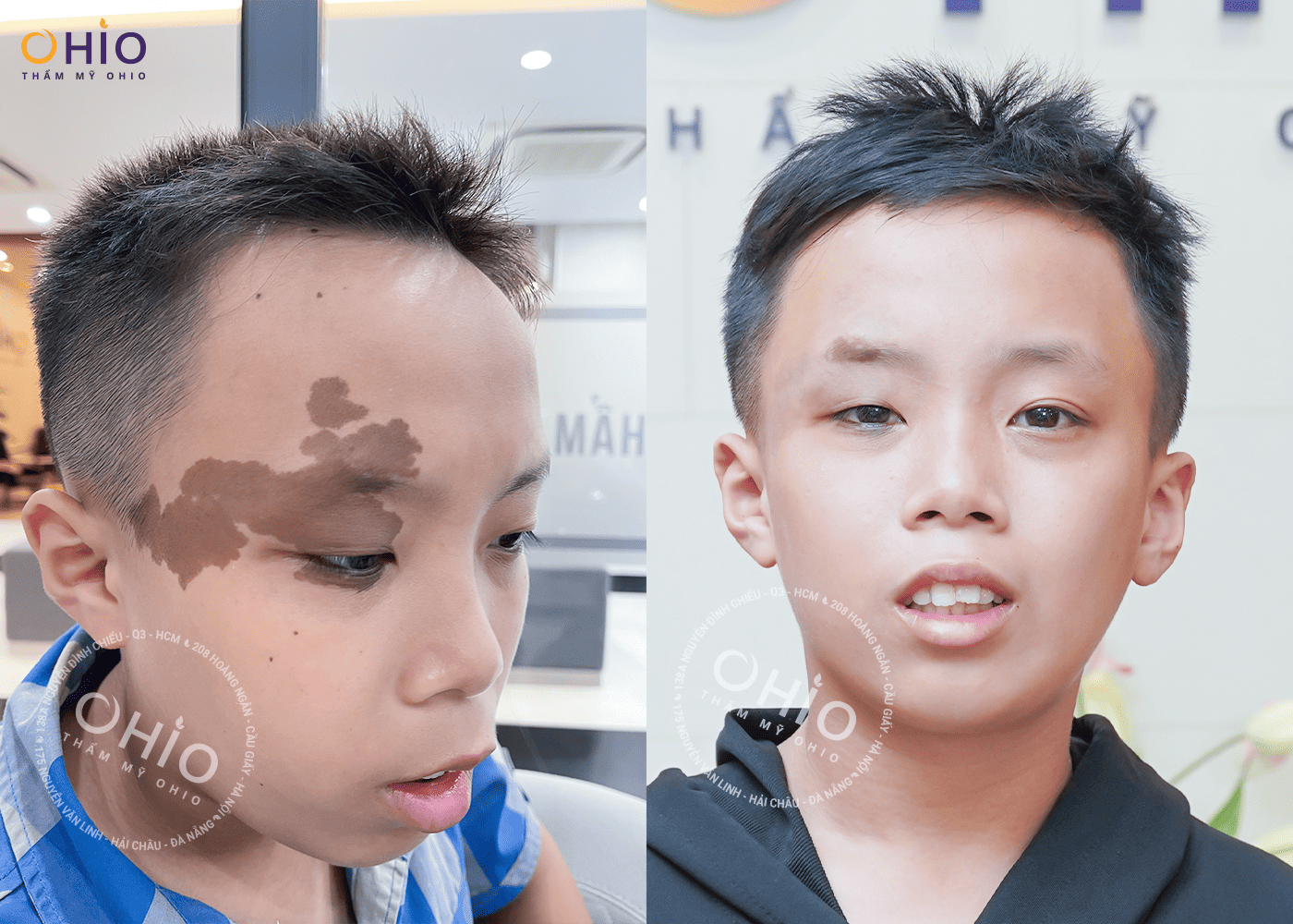 Gia đình Đức Anh: Lựa chọn xóa chàm cho con tại OHIO là sáng suốt! - Phòng khám da liễu OHIO Gia đình Đức Anh: Lựa chọn xóa chàm cho con tại OHIO là sáng suốt!