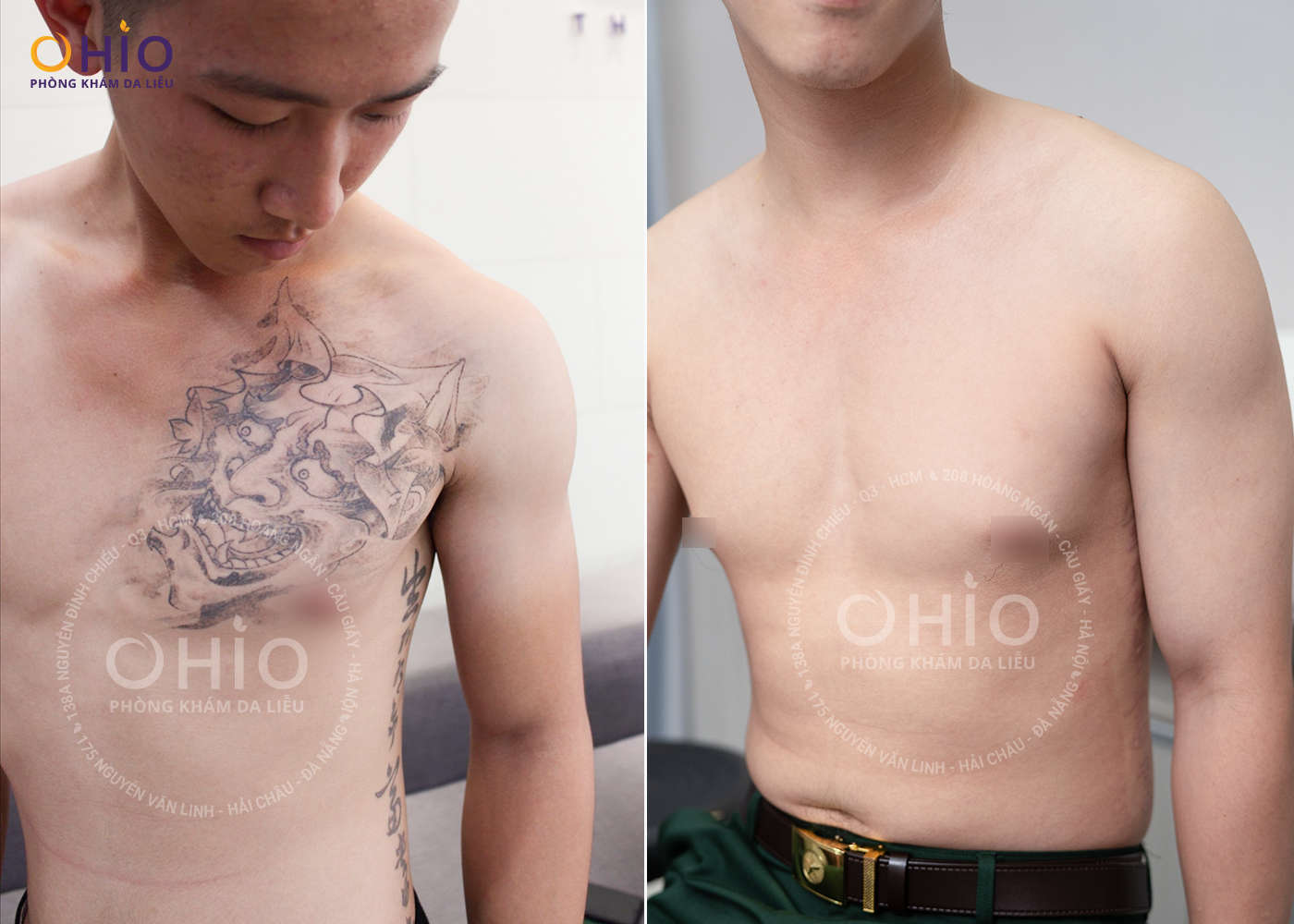 Xóa hình xăm sạch mực với phác đồ PICO 3X 2025 - Phòng khám da liễu OHIO Xóa hình xăm sạch mực với phác đồ PICO 3X 2025